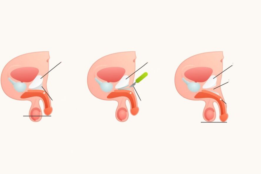 Ligamentotomy increases penis