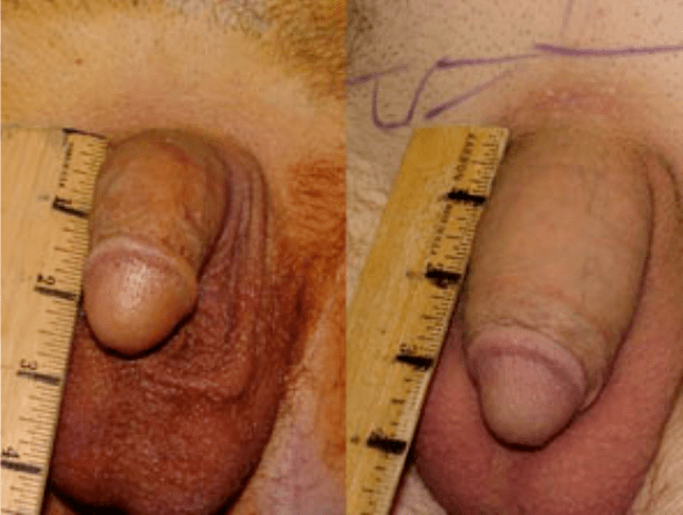 Before and after lipofilling and gel implants