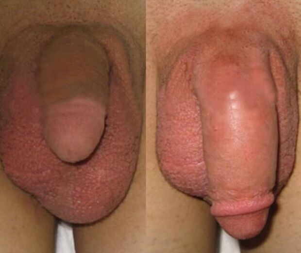 Results of installing a collagen matrix in the penis
