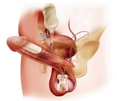 surgical penis enlargement