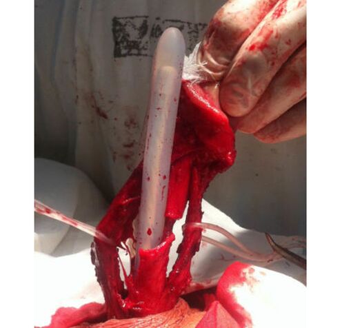 Muscle tissue transplant to enlarge penis