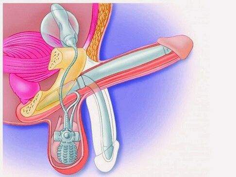 Penis Enlargement with Penile Implants